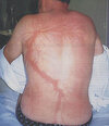 Scars-After-Surviving-Lightning-Strike-Lichtenberg-Figures-Photos-17-5b6d30af76710__700.jpg